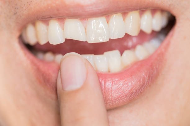 Don't let a chipped tooth spoil your smile
