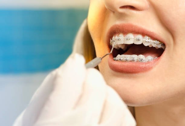 Woman having dental braces at SmilePoint Dental - dentist in Point Cook, Altona Meadows, Laverton and Seabrook.