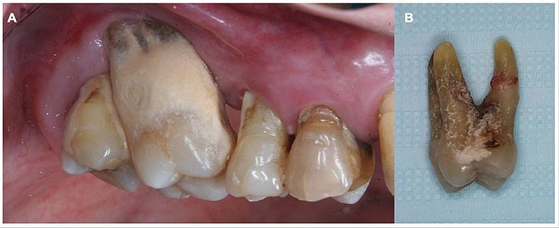 Gum Disease And Periodontitis Effects and Treatments
